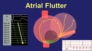 Atrial Flutter  Fundamentals of Diagnosis and Ablation [upl. by Nnadroj319]