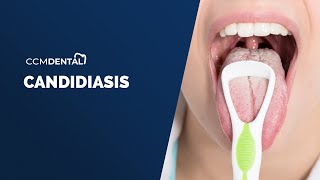 Candidiasis Oral  Síntomas causas y tratamiento por Javier Alberdi CCM Dental [upl. by Derte209]