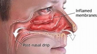 How to Cure Postnasal Drip Removing Allergens from Your Environment and Using Unverified Natural [upl. by Dnomar]