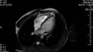 Cardiología HU  Resonancia Magnética Cardiaca Normal [upl. by Noremak]