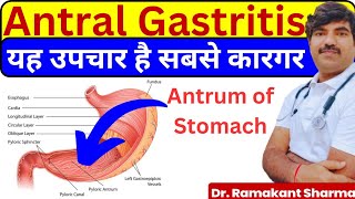 Antral Gastritis Causes Symptoms and Effective Treatments drramakantsharma7 [upl. by Adnamal44]