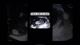 acrania anencephaly fetus ultrasound fetalanomaly [upl. by Yllaw674]