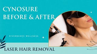 Cynosure Laser Hair Removal Before amp After  What You Need to Know [upl. by Krid]