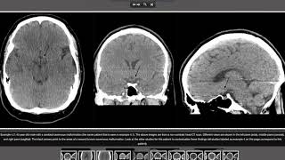 Condition Specific Radiology Cerebral Cavernous Malformation [upl. by Conley108]