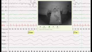 Periodic Limb Movements [upl. by Grove]