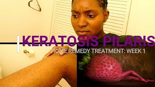 HOW TO REMOVE KERATOSIS PILARIS Week 1 Home Remedy Treatment [upl. by Henig]