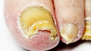 Get Rid of Toenail Fungus Doctor Recommended Home Guide [upl. by Varden]