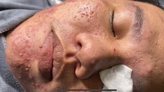 Blackheads amp Pimples Pore Removal New 2024FULL  Acne Treatment With Bo Nguyễn Spa [upl. by Mutat]