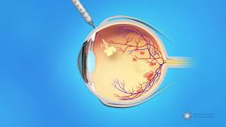 Eye Injections for Central Retinal Vein Occlusion CRVO [upl. by Merv]