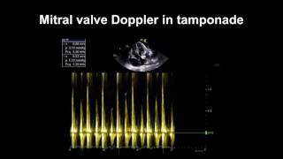 Echocardiography Essentials Detecting pericardial effusions [upl. by Elleinnod]