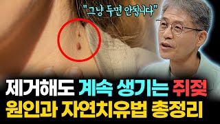 지긋지긋한 쥐젖 이렇게 치료해보세요 쥐젖뿐만 아니라 삶이 획기적으로 변화됩니다 [upl. by Dreher]