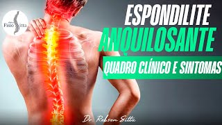 EXAME FÍSICO QUADRO CLÍNICO e SINTOMAS ESPONDILITE ANQUILOSANTE  Fisioterapia Dr Robson Sitta [upl. by Bradlee727]