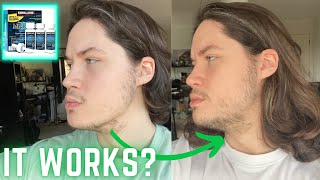 Minoxidil 9 Months Update FINALLY PROGRESS [upl. by Sergeant]