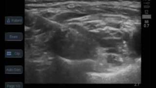 ultrasound guided supraclavicular brachial plexus block [upl. by Kone353]