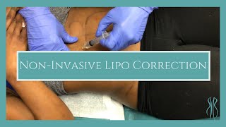 NonInvasive Lipo Correction [upl. by Htenek]