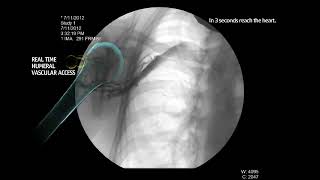 EZ IO Infusion Fluoroscopy Proximal Humerus [upl. by Faxun]