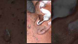 Daily pimples blackheads ingrown hair😍 shorts [upl. by Oratnek958]