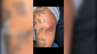 Popping huge blackheads and Pimple Popping  Best Pimple Popping Videos 158 [upl. by Irallih]