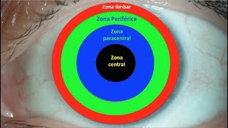 Zonas de la superficie corneal importantes en cirugía Centro de Oftalmología Bonafonte [upl. by Tshombe]