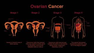 Stages of Ovarian Cancer [upl. by Refinnaj376]