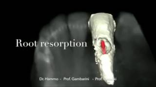 Resorption case [upl. by Mattheus]