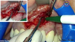 Dr Korkut Aldemir  Maxillary Odontogenic Radicular Cyst [upl. by Cilurzo635]