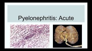 Pyelonephritis Acute [upl. by Fisken929]