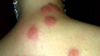 Bed Bug Bites Pictures of Bed Bug Bites  Gross Pictures of Bed Bug Bites [upl. by Luamaj974]