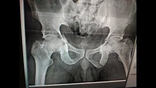 Acetabulum Percutaneous technique  Dr Ramprasad K MSORTHO AIIMS FAOA AUS A1 ORTHOCARE [upl. by Thursby]