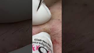 Blackhead Removal Acne Removal Treatment 08 [upl. by Sivrad]