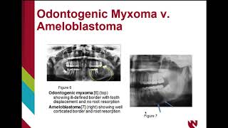 Odontogenic myxoma [upl. by Isabea829]