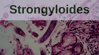 Strongyloides and Strongyloidiasis  Pathology mini tutorials [upl. by Burny]