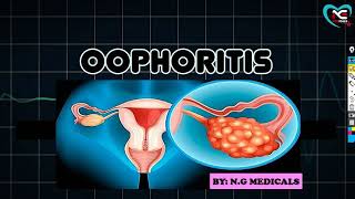 OOPHORITIS WITH EASY NOTES  FLL EXPLANATION IN HINDI BY NG MEDICALS [upl. by Rebor]