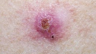 Basal Cell Carcinoma Symptoms Causes and Treatment  First Aid  Made Easy [upl. by Enehs224]