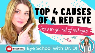 How To Get Rid Of Red Eyes  Top 4 Causes Of A Red Eye  An Optometrist Dishes all the Dirt [upl. by Eirased]