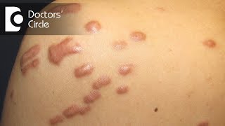 What is the best treatment for Keloid in young people  Dr Pavan Murdeshwar [upl. by Oderfliw352]