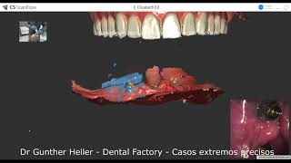 Extreme occlusal registration Carestream with ScanFlow Case by Dr Gunther Heller  Dexis Envista [upl. by Lauri]