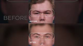 Transformative Upper Eyelid Lift Discover Dr David Stokers Secrets [upl. by Castorina]