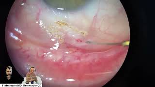 Cautery of Conjunctiva and Conjunctival Cyst to treat chronic eye irritation [upl. by Ecnerat34]