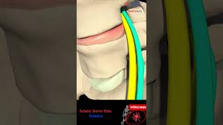 Sciatic nerve pain  Sciatica pathophysiology causes and treatment [upl. by Huff]