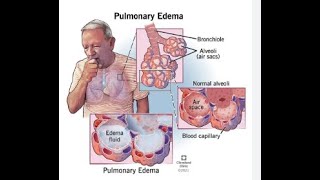 Pulmonary EdemaCardiogenic Pulmonary edemaNonCardiogenic Pulmonary edemaRespitory Therapist [upl. by Casey]