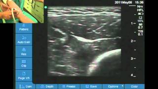 Ultrasound location of radial nerve at elbow [upl. by Otreblon]