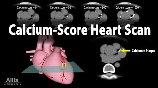 Calcium Score Heart Scan Animation [upl. by Nho]