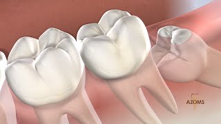 Wisdom Teeth Removal in Tucson AZ  Arizona Oral amp Maxillofacial Surgeons [upl. by Ahteral]