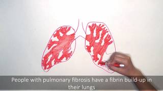 Progressive Pulmonary Fibrosis What Patients Need to Know webinar [upl. by Lalla]