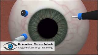 Vitrectomy animation  Retina Center Tijuana [upl. by Arenahs503]