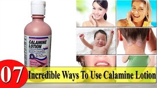 7 Incredible Ways To Use Calamine Lotion [upl. by Aciraa849]