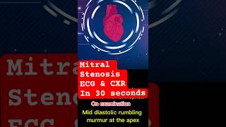 mitralvalve stenosis ecg xray shortnessofbreath cardiology mbbsstudent doctor [upl. by Bergren]