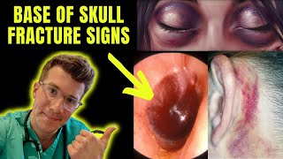 Clinical Signs of Base of Skull Fracture  including Racoon eyes Battles Sign amp more [upl. by Eninnaej]