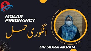 Molar pregnancy انگوری حمل Dr Sidra Akram [upl. by Barrie]